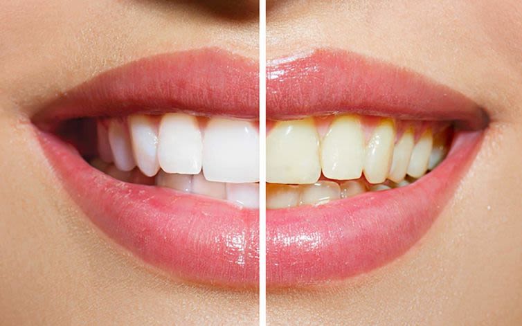 A satisfied patient with a radiant, white smile, symbolizing the confidence boost from effective teeth whitening Telford
