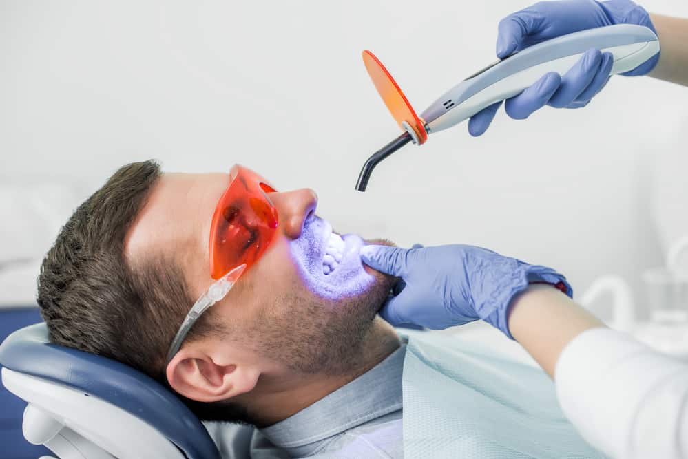 Why Laser Teeth Whitening is the Top Choice for Smokers Telford
