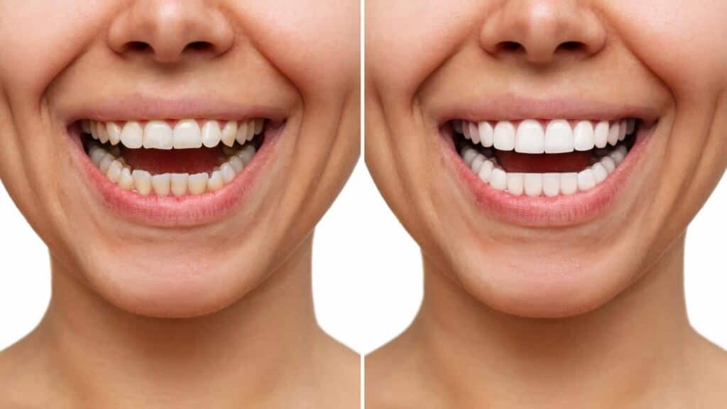 Contact Aspire White for teeth whitening services – Get in touch with Telford today