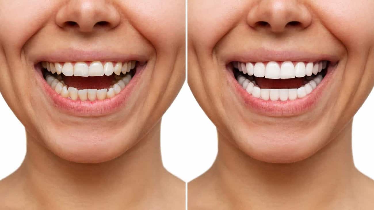 Contact Aspire White for teeth whitening services – Get in touch with Telford today