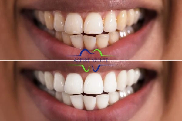 Aspire White customer before and after Telford results.
