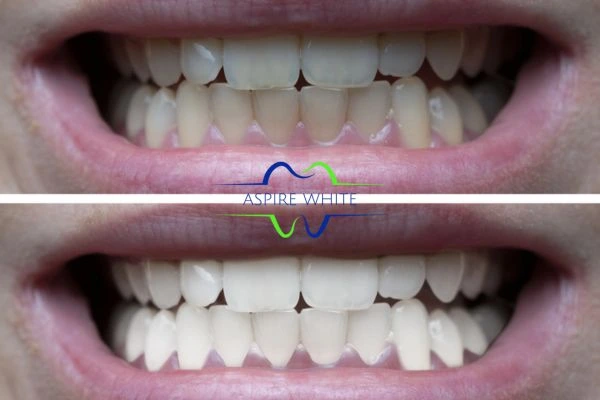 1 hour laser teeth whitening before and after results Telford