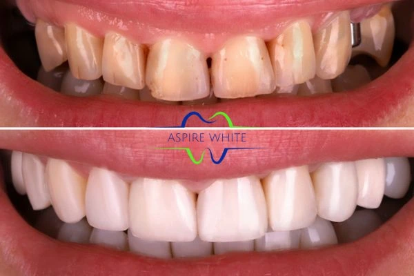 Before and after comparison of smokers Telford teeth following a laser whitening treatment