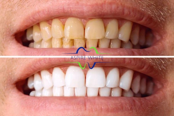Get noticeable whiter smile in just one hour! Book your teeth whitening treatment Telford today!