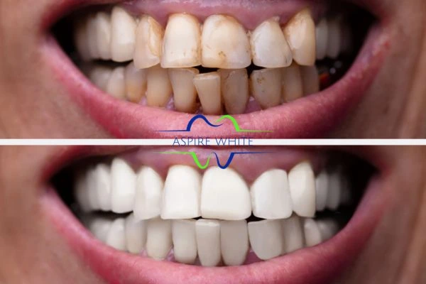Before and after results of laser teeth whitening Telford Book in online today!