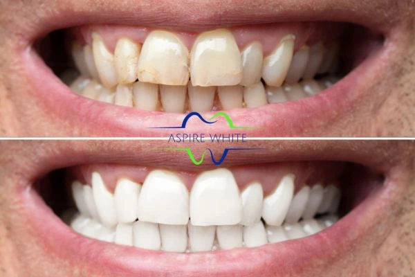 Achieve a radiant smile with professional laser teeth whitening Telford